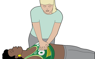 Illustration of woman receiving chest compressions Illustration of woman receiving chest compressions