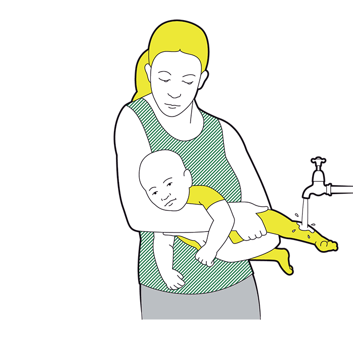 Minor Burns Baby First Aid Advice St John Ambulance